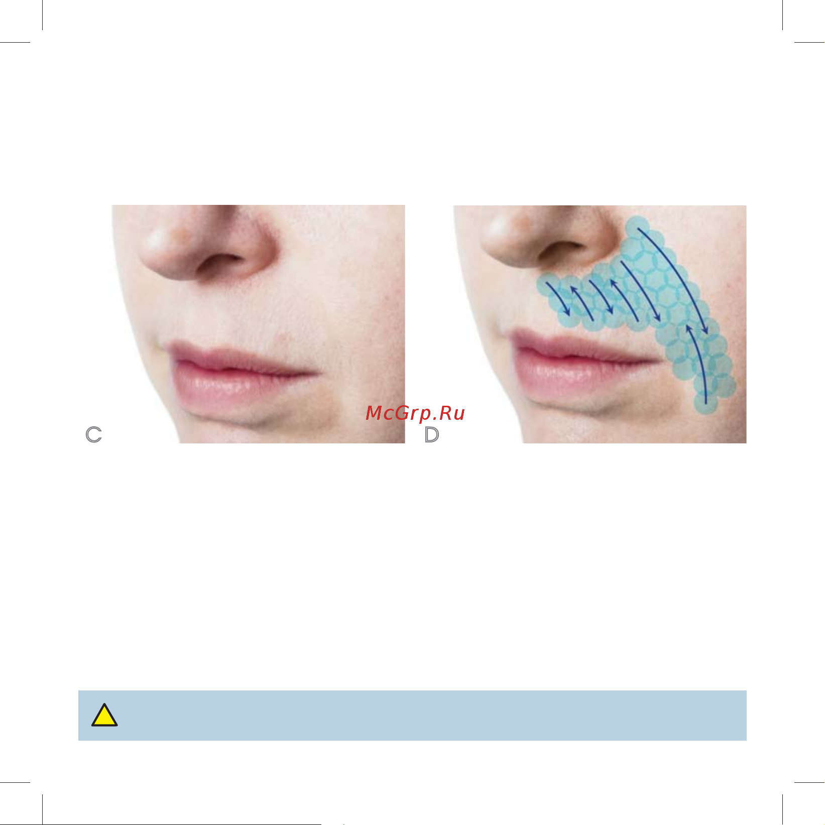 Iluminage Skin Smoothing Laser [49/76] Øàã 4 çîíû ïðèìåíåíèß c è d