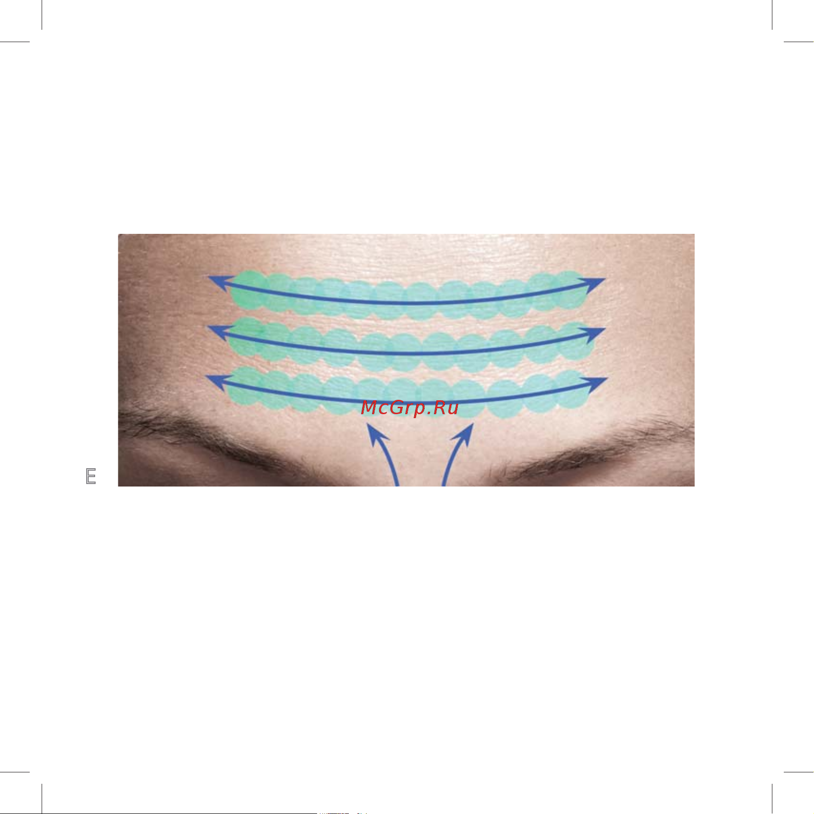 Iluminage Skin Smoothing Laser [50/76] Øàã 5 çîíà ïðèìåíåíèß å