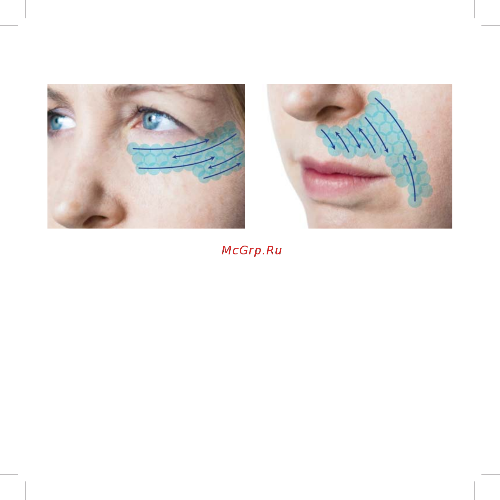 Iluminage Skin Smoothing Laser [52/76] Ïîñëå ïåðâîé ïðîöåäóðû