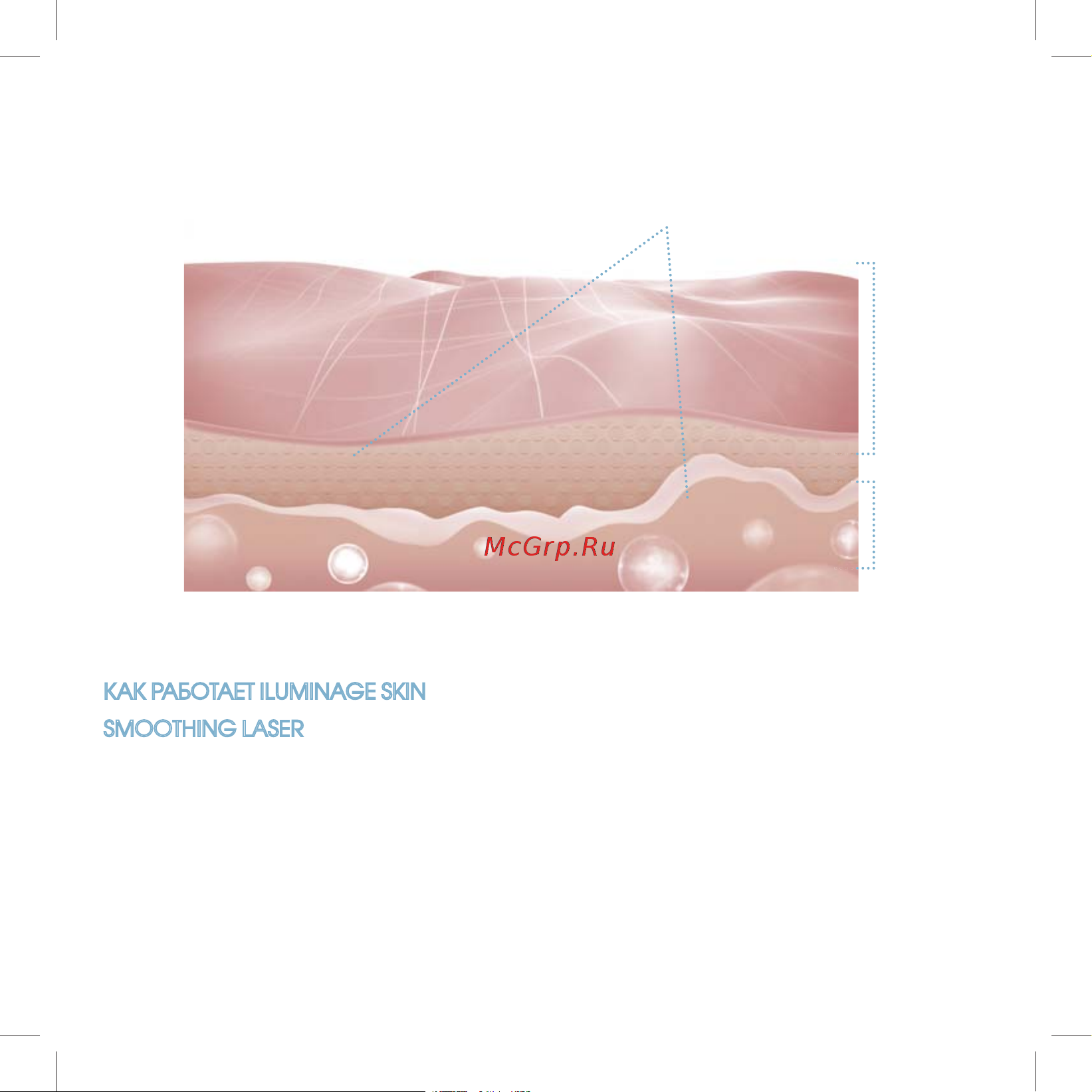 Iluminage Skin Smoothing Laser [7/76] Smoothing laser